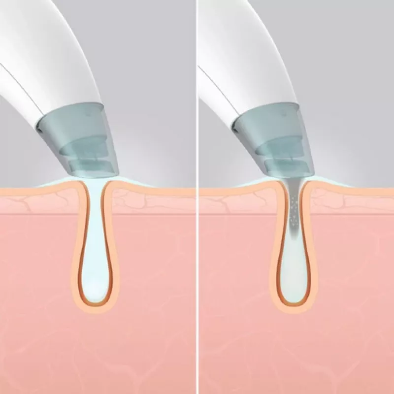 HoMedics FAC-HY100 Hautpflegegerät Hydradermabrasion-Reiniger Transparent, Weiß
